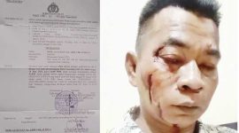 Foto: Moh Ali Hasan, korban dugaan pengeroyokan yang dilakukan anak dan orang tua di dusun Taroh, Kecamatan Ambunten 